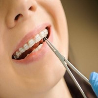Invisible braces dentist